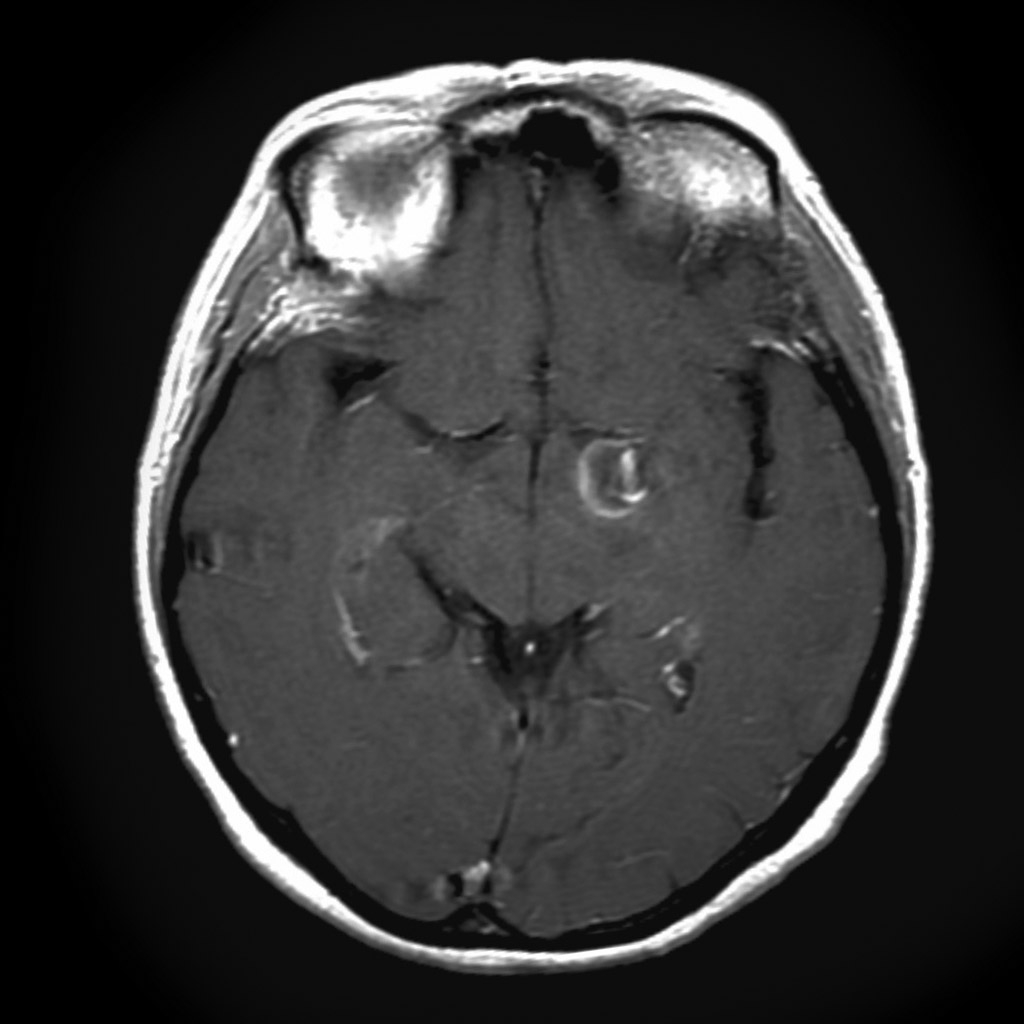 Modality: MRI (T1 C+) .