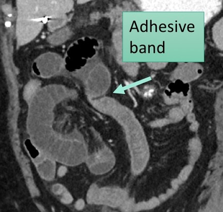 Intra Abdominal Adhesions