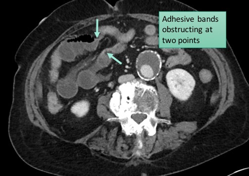 Closed loop small bowel obstruction - adhesions | Image | Radiopaedia.org