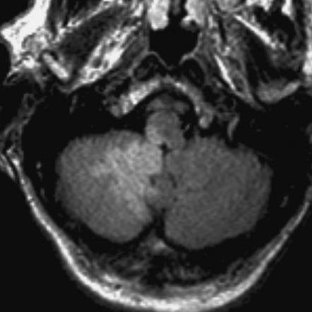 Cerebellar Stroke Mri