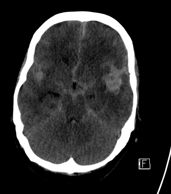 cerebral aneurysm ct