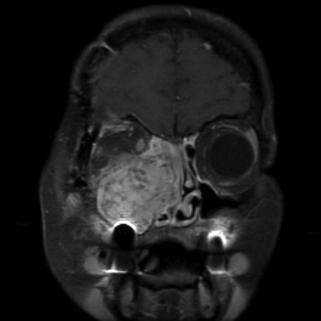 Менингиома в голове что это такое. Менингиома основания черепа. Менингиома основания черепа мрт.