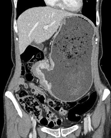 Gastric outlet obstruction - gastric adenocarcinoma | Image ...