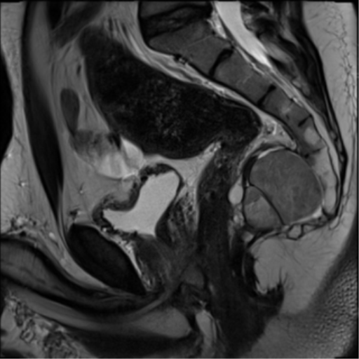 Currarino syndrome | Image | Radiopaedia.org