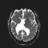 Open lip schizencephaly | Image | Radiopaedia.org