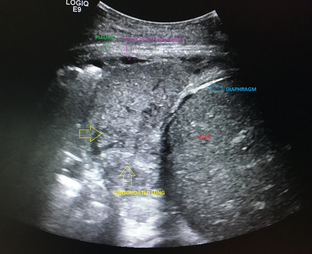 Pneumonia Ultrasound Pneumonia