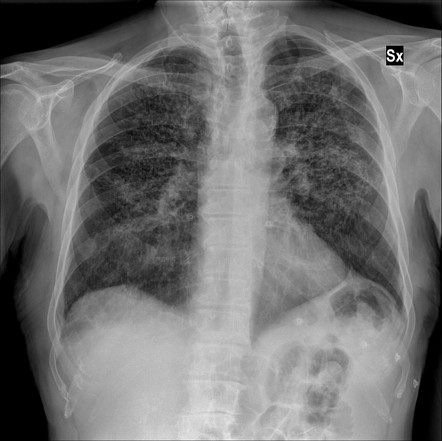 Pulmonary Langerhans cell histiocystosis | Radiology Case | Radiopaedia.org