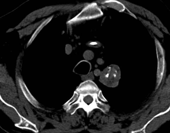 Pulmonary hamartoma | Image | Radiopaedia.org