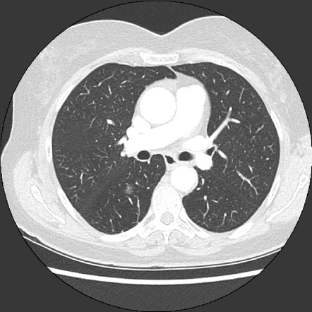 Pure ground glass nodules | Radiology Reference Article | Radiopaedia.org