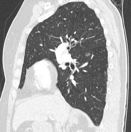 Minimally invasive adenocarcinoma of the lung | Image | Radiopaedia.org