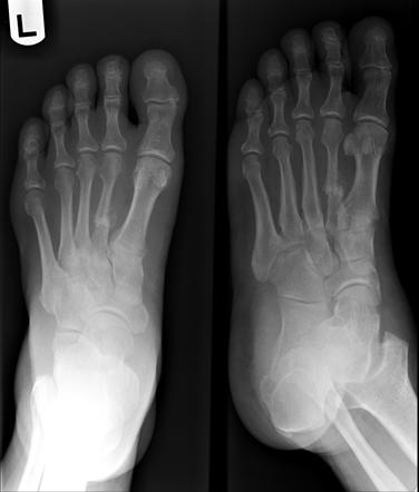 Lisfranc fracture-dislocation in Charcot foot | Image | Radiopaedia.org