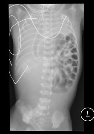 Congenital Diaphragmatic Hernia Radiology Reference Article Radiopaedia Org