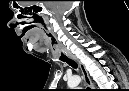 Epiglottitis CT Scan