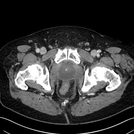 Prostatic abscess | Radiology Reference Article | Radiopaedia.org