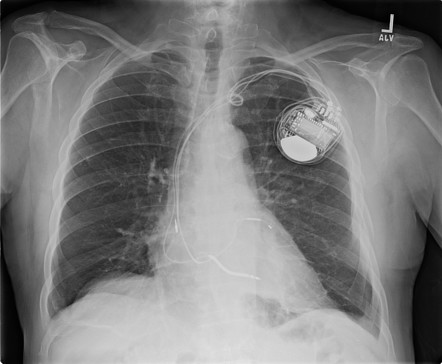 Fibrothorax after rib fractures | Radiology Case | Radiopaedia.org