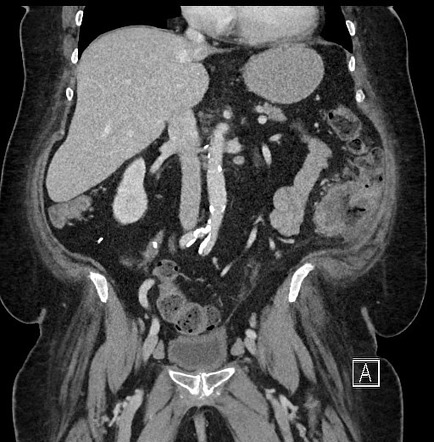 Colorectal cancer | Radiology Reference Article | Radiopaedia.org