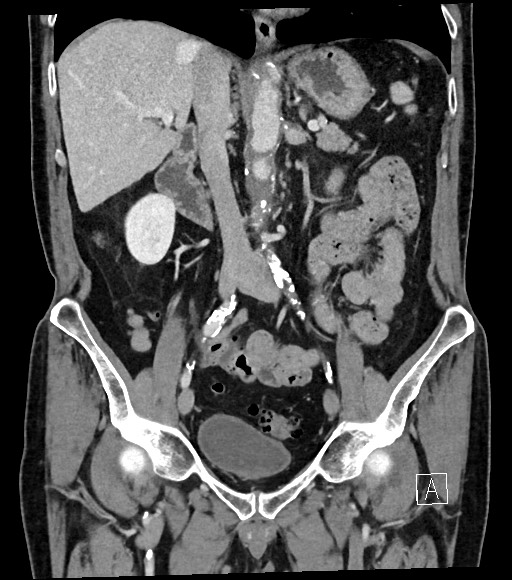 Acute renal infarction | Image | Radiopaedia.org