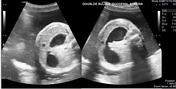 Double bubble sign (duodenum) | Radiology Reference Article ...