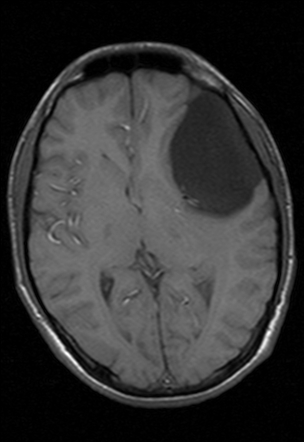 Large Arachnoid Cyst - Middle Cranial Fossa 