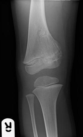 Intraosseous lipoma - distal femur | Radiology Case | Radiopaedia.org