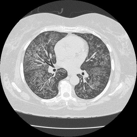 Pulmonary alveolar proteinosis | Radiology Case | Radiopaedia.org