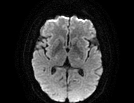 Infectious Labyrinthitis 