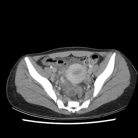 case study 68 pelvic inflammatory disease