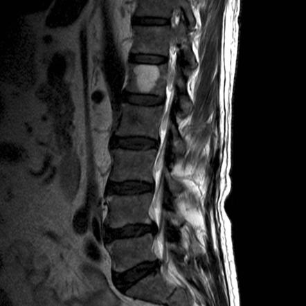 Vertebral hemangioma | Radiology Reference Article | Radiopaedia.org