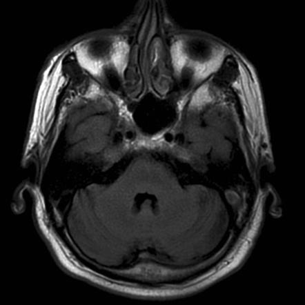 Dural Venous Sinus Thrombosis Radiology Reference Article