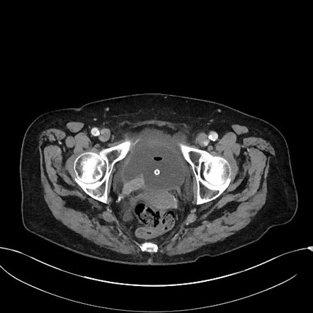 Ureteral stump tumor with urine leak | Radiology Case | Radiopaedia.org