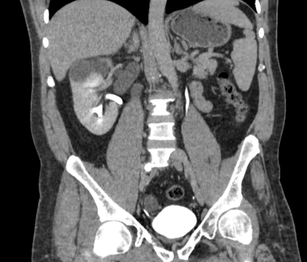 Ectopic ureter insertion into the prostatic urethra | Radiology Case