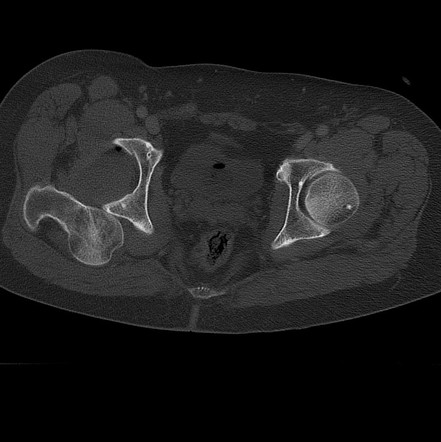 Posterior Dislocation Of The Hip 