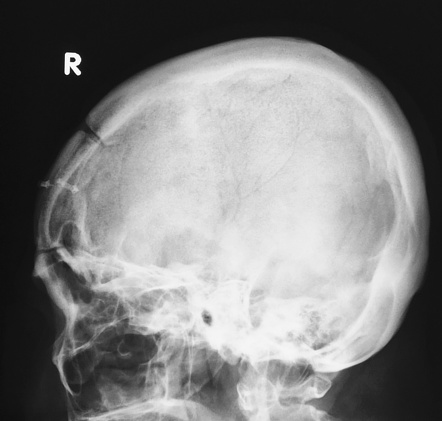 Craniotomy  Radiology Reference Article  Radiopaedia.org