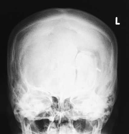 Frontal craniotomy | Image | Radiopaedia.org