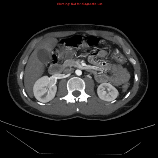 Circumaortic Left Renal Vein Image