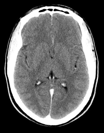 Pilocytic astrocytoma | Image | Radiopaedia.org