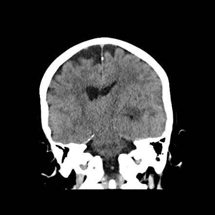 Meningiomas - Radiation-induced | Image | Radiopaedia.org