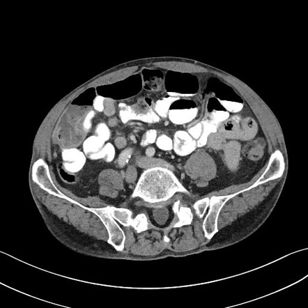 Severe gastritis and chronic calcific pancreatitis | Image ...