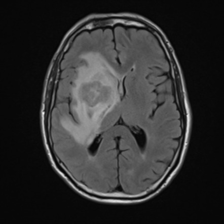 Primary diffuse large B-cell lymphoma of the CNS | Image | Radiopaedia.org