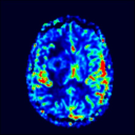 Primary diffuse large B-cell lymphoma of the CNS | Image | Radiopaedia.org