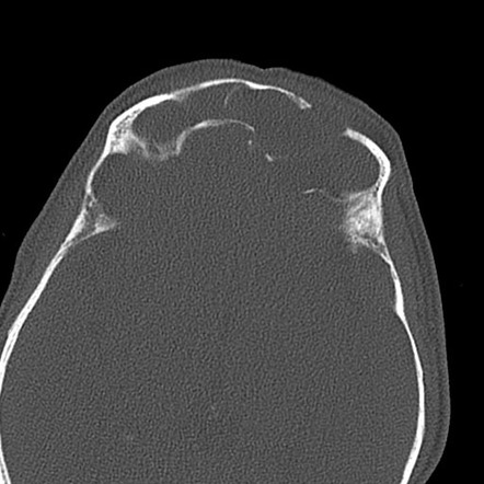 Frontal mucocele | Radiology Reference Article | Radiopaedia.org