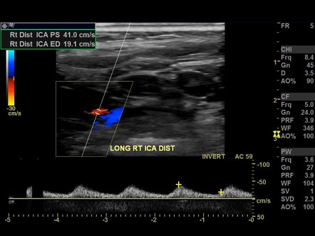 Tardus parvus | Radiology Reference Article | Radiopaedia.org