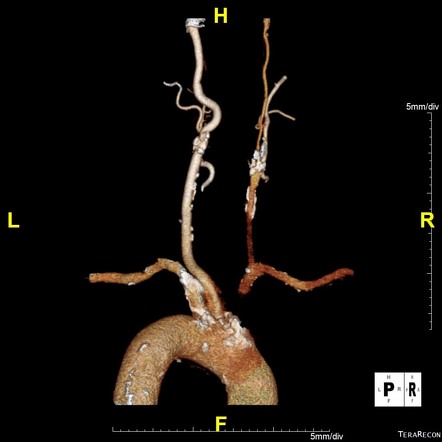 Subclavian steal syndrome | Radiology Reference Article | Radiopaedia.org