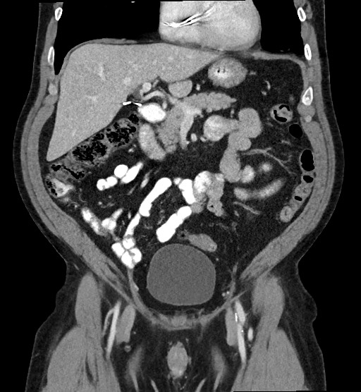 Pancreas divisum | Image | Radiopaedia.org