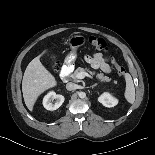 Pancreatic Divisum Radiology