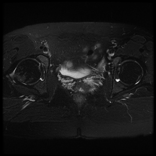 Unicornuate uterus with renal anomaly | Image | Radiopaedia.org