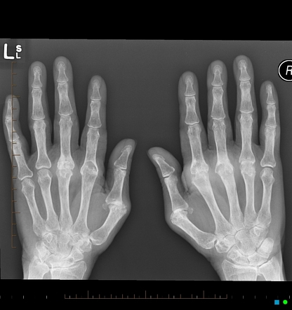 Rheumatoid Arthritis Hands Radiology Case Radiopaedia Org