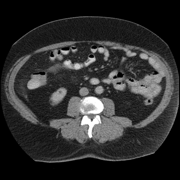 Stump Appendicitis Image