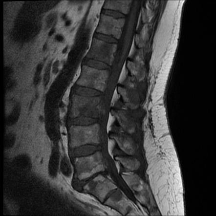 Prostate cancer | Radiology Reference Article | Radiopaedia.org