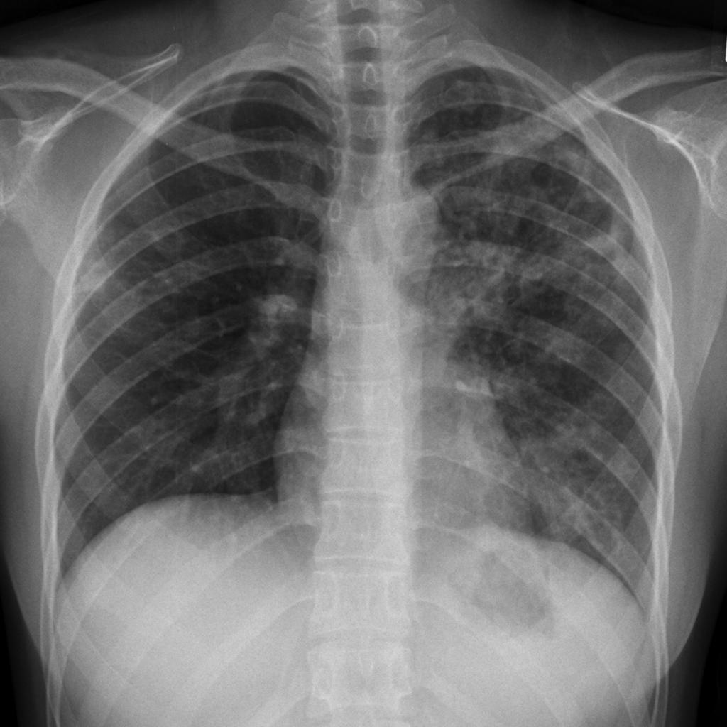 tuberculosis-lung-x-ray